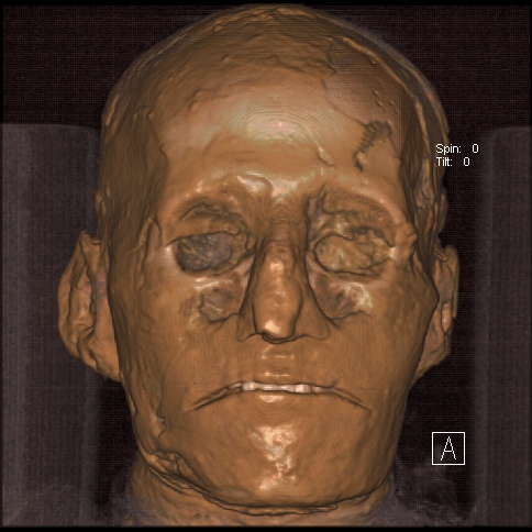 Albert Zink - 3d-reconstruction-mummy-ramsesiii_copyright_zink