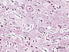 Mózg osoby cierpiącej na chorobę Alzheimera