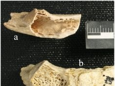 Monge J, Kricun M, Radovčić J, Radovčić D, Mann A, et al. (2013) Fibrous Dysplasia in a 120,000+ Year Old Neandertal from Krapina, Croatia. PLoS ONE 8(6): e64539. doi:10.1371/journal.pone.0064539