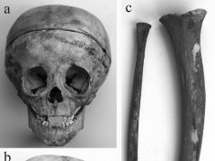 Giuffra, V., Vitiello, A., Caramella, D., Fornaciari, A., Giustini, D. and Fornaciari, G. (2013), Rickets in a High Social Class of Renaissance Italy: The Medici Children. Int. J. Osteoarchaeol.. doi: 10.1002/oa.2324