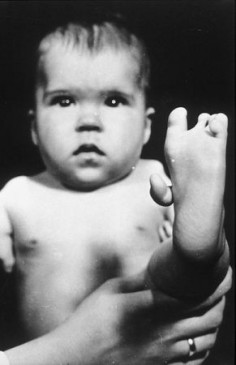Malformacja stopy u dziecka kobiety zażywającej talidomid w czasie ciąży (1962)© United States Department of Health and Human Services