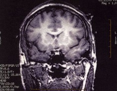 Skan mózgu za pomocą fMRI