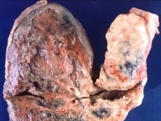 Pulmonary Pathology, CC