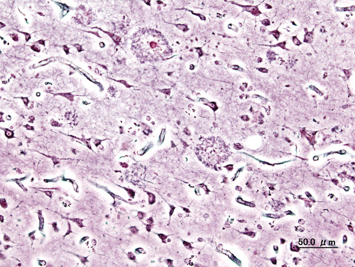 Rewolucja w myśleniu o alzheimeryzmie?