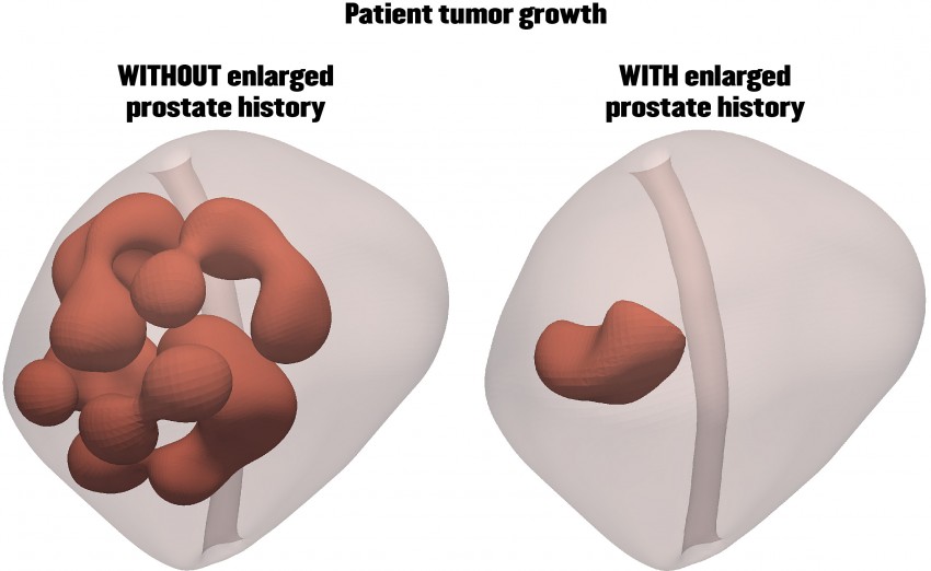 enlarged prostate forums cum se face masajul pentru prostatita