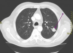 Rak płuc na zdjęciu wykonanym z wykorzystaniem tomografu komputerowego
