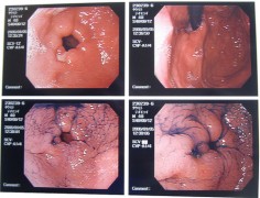 Żołądek w kamerze endoskopu
