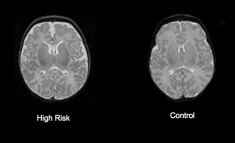 John Gilmore, UNC Schizophrenia Research Center