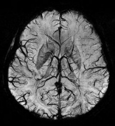 Susceptibility weighted imaging